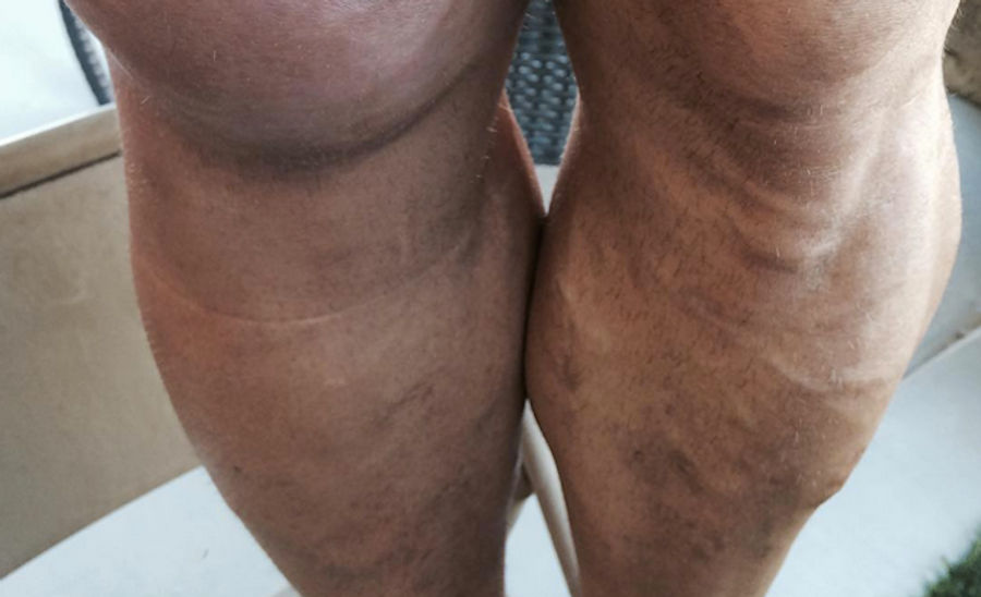 Ryback's Staph Infection Is Very Gross