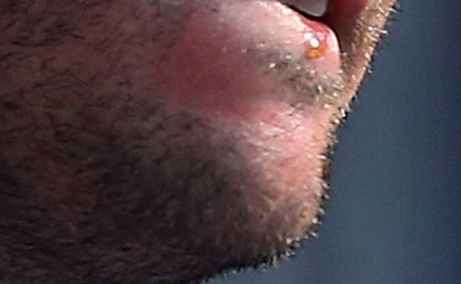 Whose Disgusting Baseball Chin Is This?