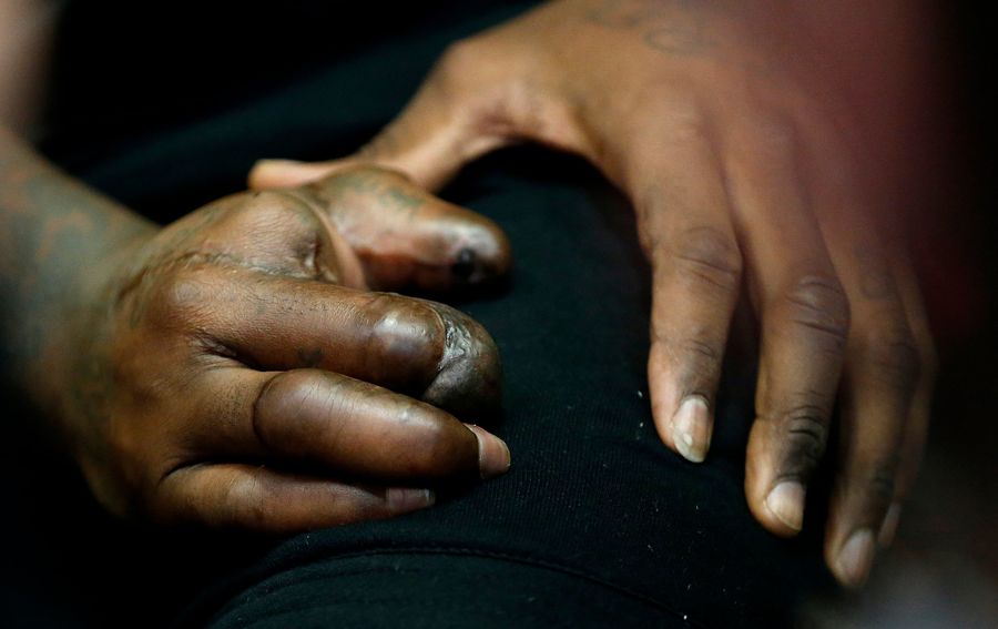 Take Your First Good Look At Jason Pierre-Paul's Mangled Hand