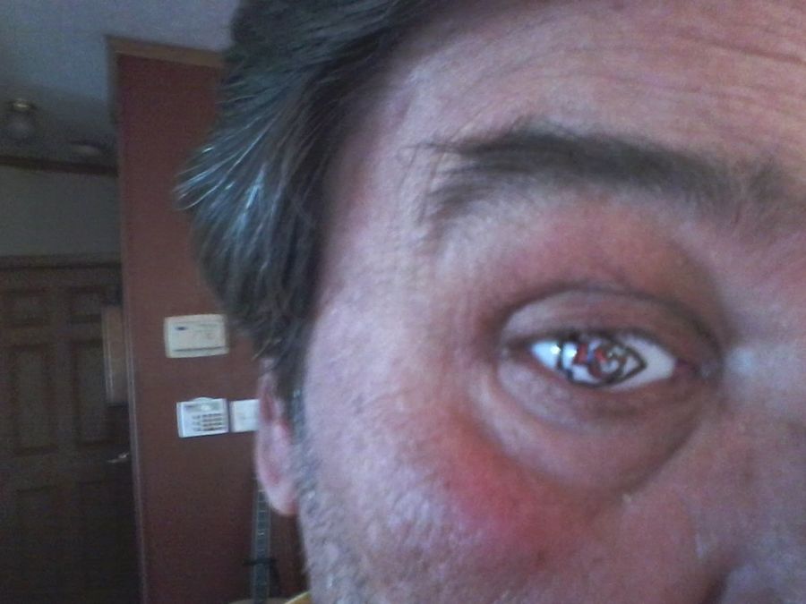 Yup, That's A Kansas City Chiefs Glass Eye