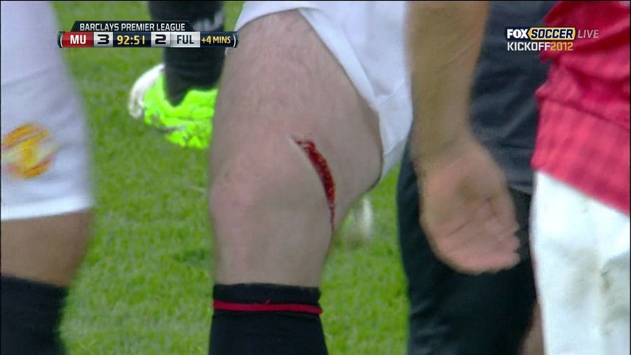 Wayne Rooney Knocked Out Of Match With Gruesome Leg Gash [UPDATE]