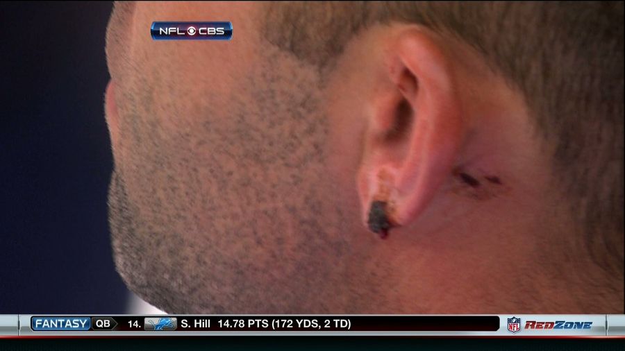 Matt Schaub Lost Part Of His Ear During Yesterday's Game