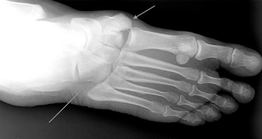 What Exactly Is A Lisfranc Injury, Anyway?