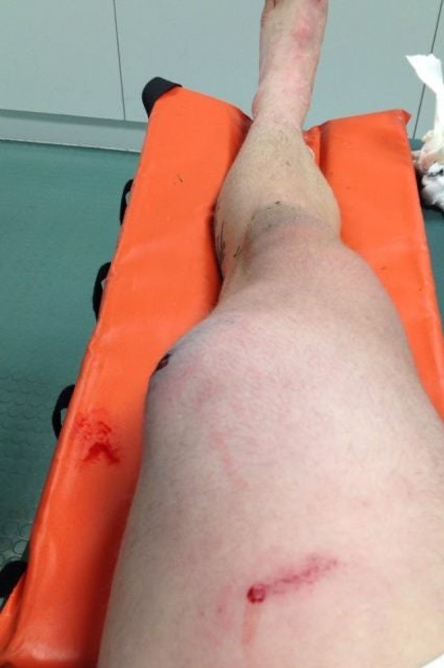 After Injury, Soccer Player Now Has Too Many Knees
