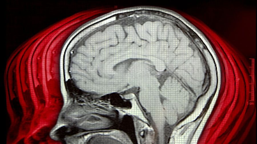 My 100 Concussions: Notes From A Terrified CTE Study Participant