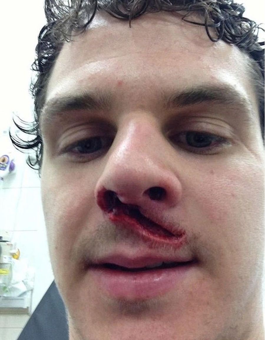 Hockey Player In UK Takes Skate To The Face And HOLY SHIT LOOK AT THAT HUGE CUT BELOW HIS NOSE