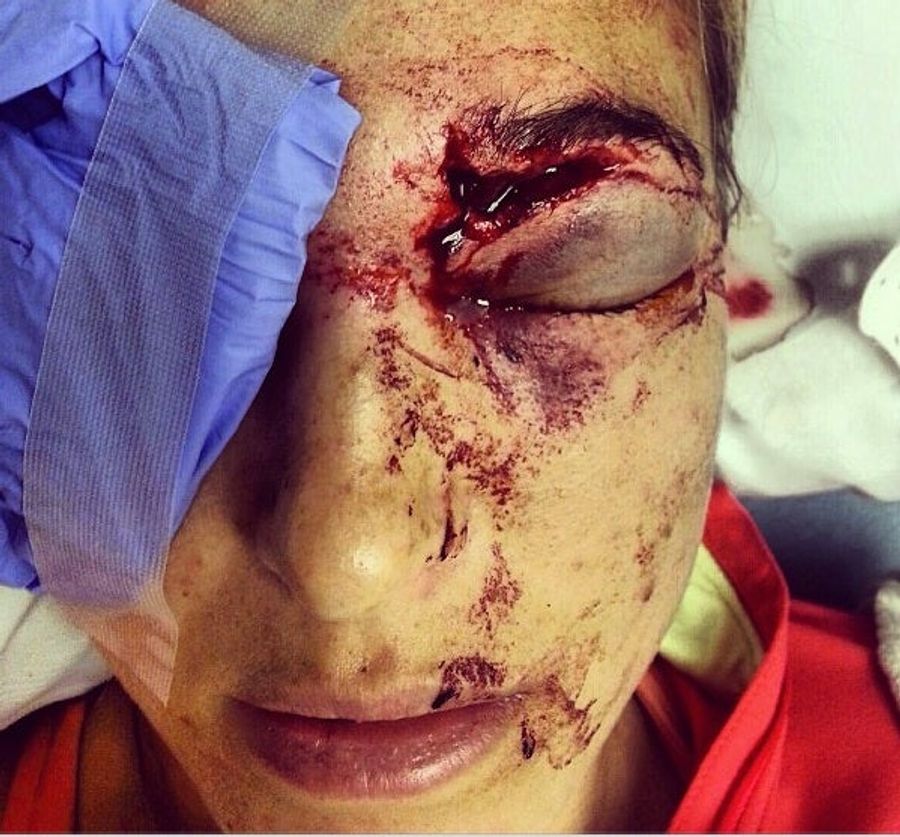 Bode Miller Accidentally Destroyed His Wife's Face With A Golf Ball