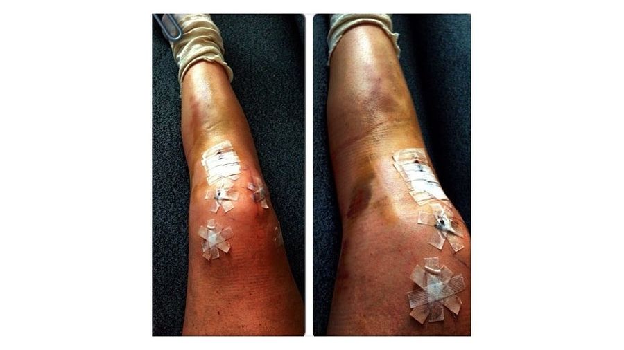Lindsey Vonn&#39;s Busted Knee Looks Like Hell