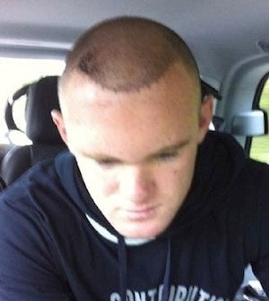 Wayne Rooney&#39;s Bloody Hair Plugs Are Literally Bloody