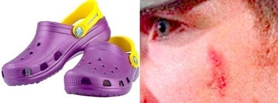 Crocs! Facial Scars! Your NFL Kickoff Open Thread