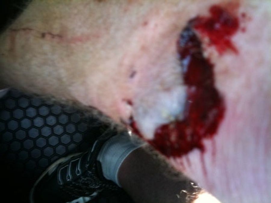 Blood Writes: This Knee Has A Mouth (WARNING: PUS)