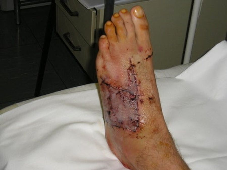Blood Writes: The Mangled Foot From Switzerland (WARNING: UGLY FOOT ALERT)