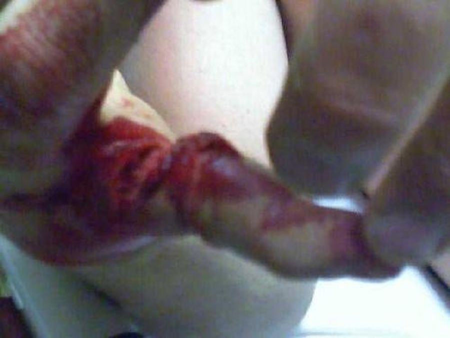 Blood Writes: This Man's Pinky Is Falling Off His Hand