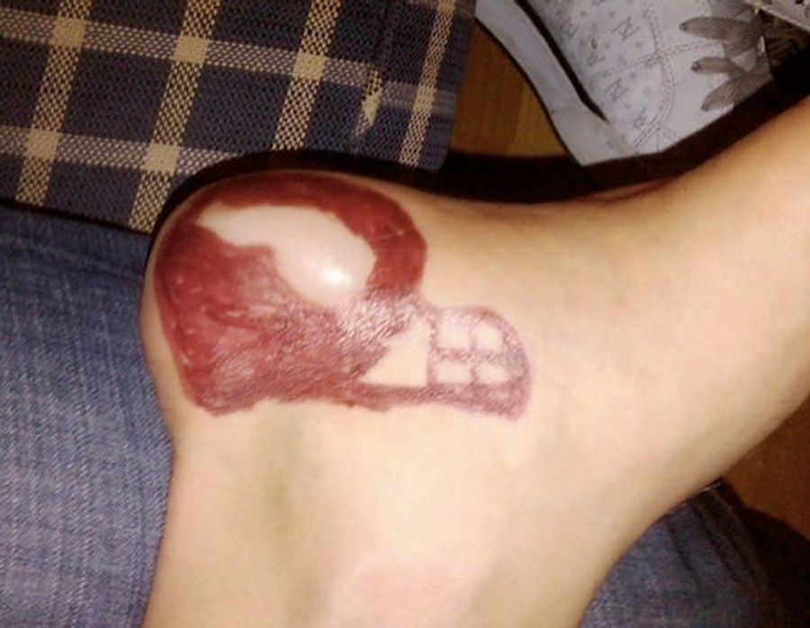 According To This Man&#39;s Pus-Filled Foot, The Vikings Are The New Team Of Destiny
