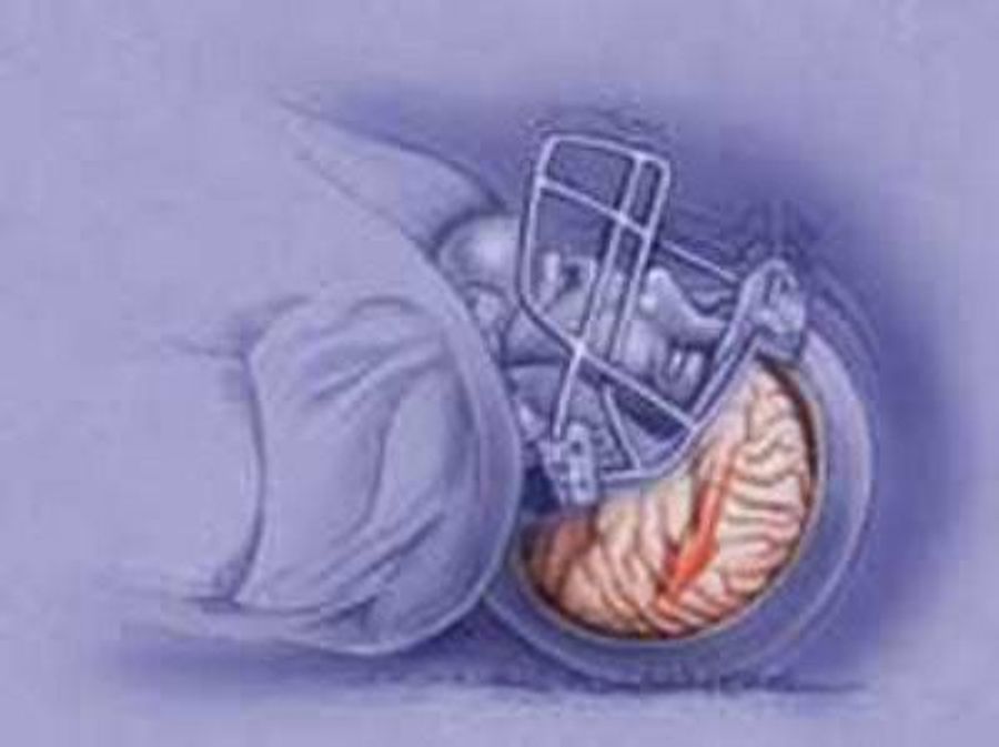 Even High School Football Players Are Destroying Their Brains