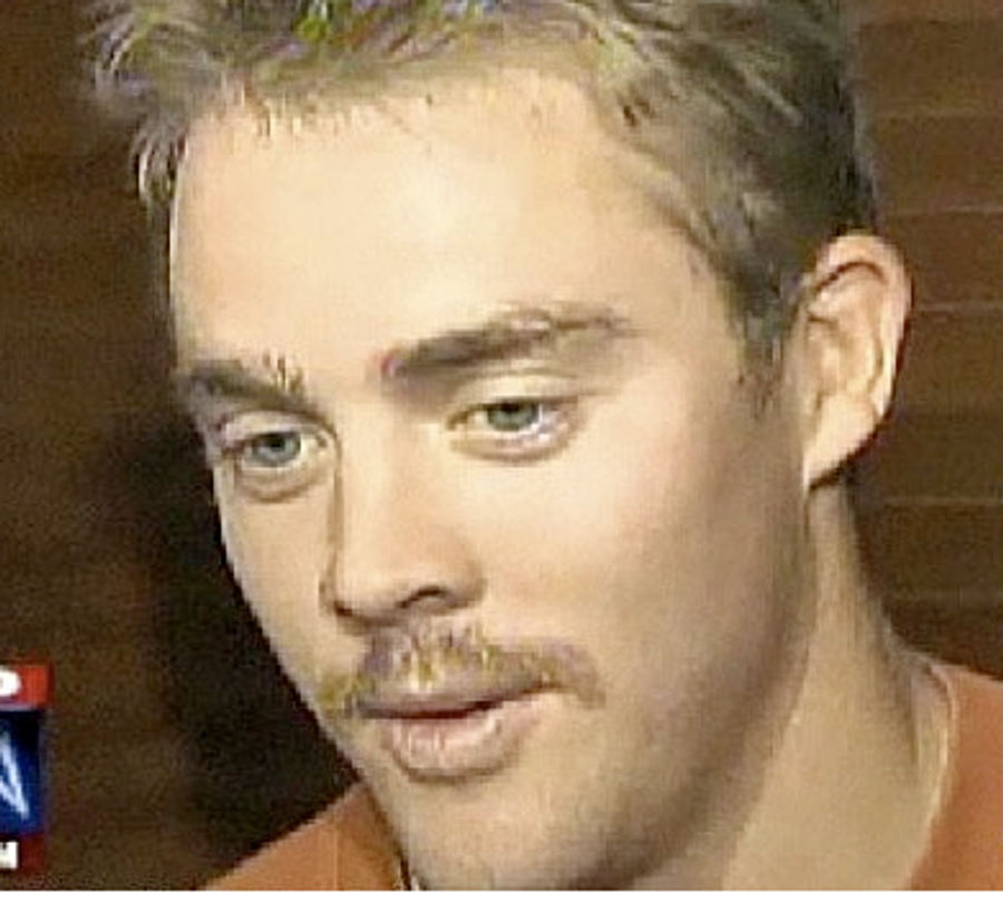 Colt McCoy Sheds His Third Eyebrow