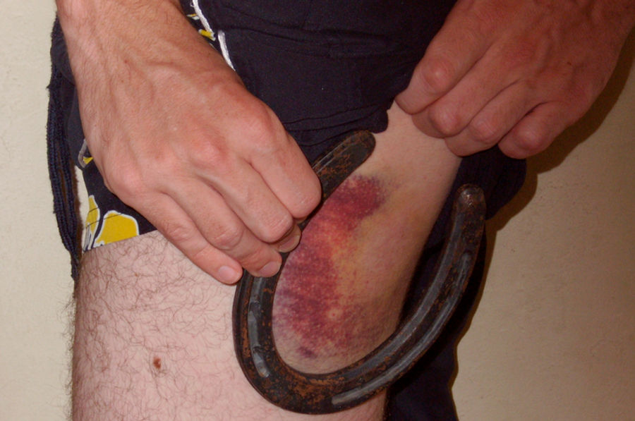 There Are So Many Ways To Make Your Leg Turn Purple