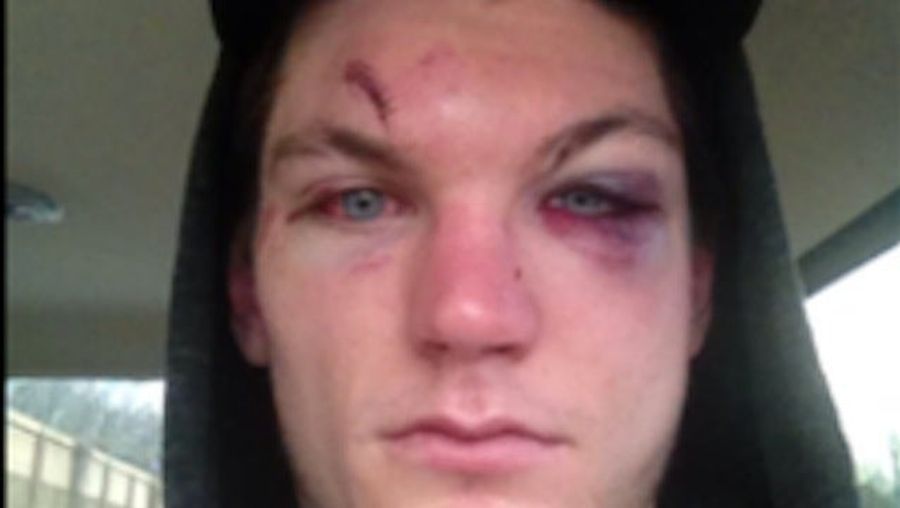 This Is What A Hockey Player Looks Like After Breaking His Face In A Fight