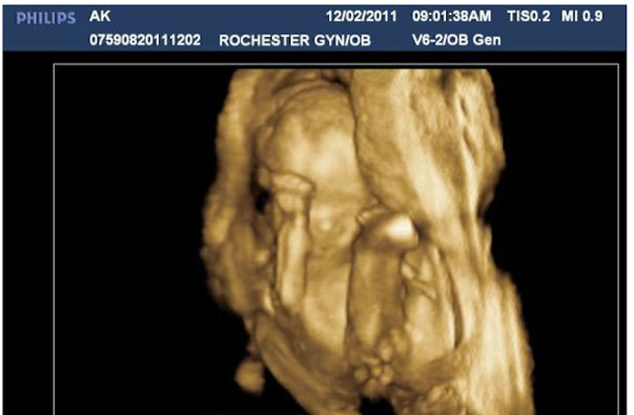 Fetuses Are Now Tebowing