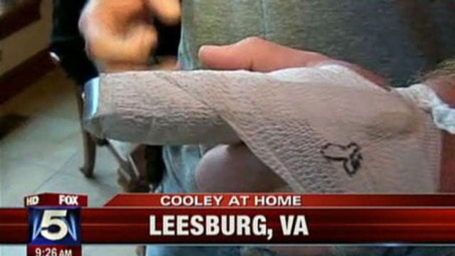 Someone Drew A Dong On Chris Cooley's Finger Cast