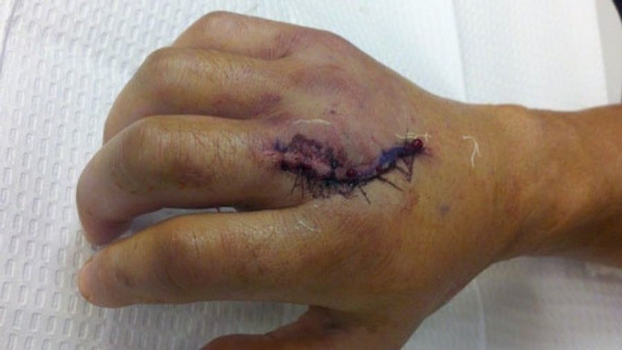 This Photo Of Dominick Cruz's Surgically Repaired Hand Is HOLY SHIT LOOK HOW BIG AND GROSS IT LOOKS