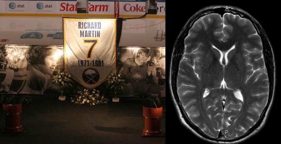 Why Sports Don&#39;t Need Concussions To Destroy Players&#39; Brains