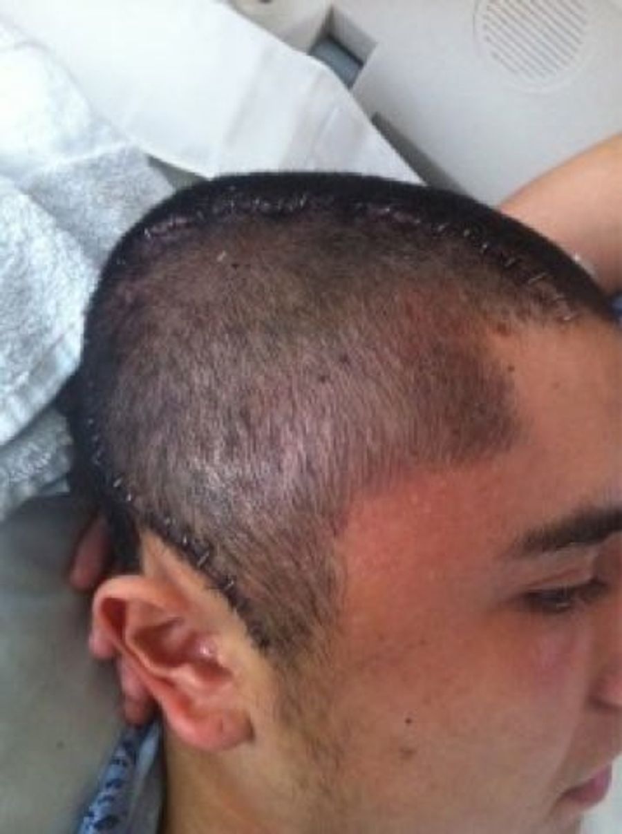 California Teen Who Required Brain Surgery After Football-Related Concussion Released From Hospital