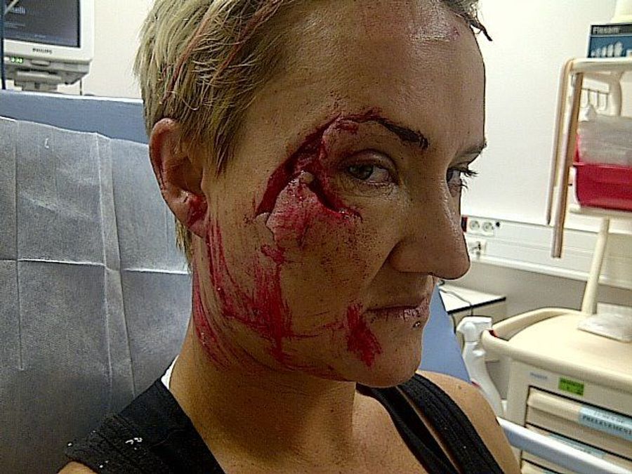 A Gruesome Wipe-Out Left This Surfer With Coral Lodged In Her Face