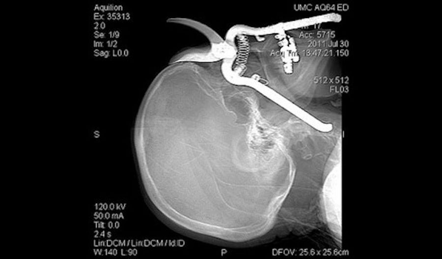 Man Drops Pruning Shears, Falls Eyesocket-First Onto Pruning Shears