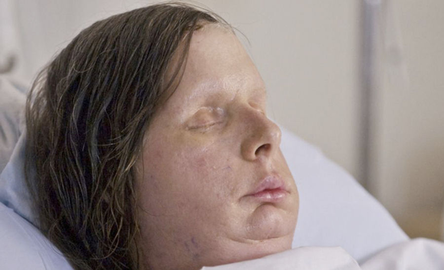 The Lady Whose Face Got Mauled By A Chimp Does Not Look Like A Lady Whose Face Got Mauled By A Chimp Anymore
