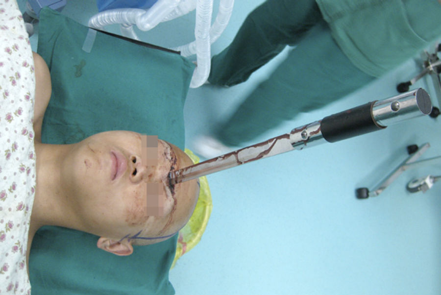 This Is How Gruesome It Looks When A Sword Gets Embedded In Someone's Head (NSFW)
