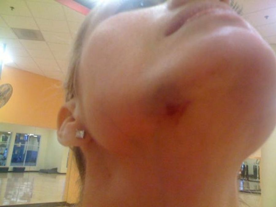 Erin Andrews Has Been Posting Pictures Of Various Bruises In Recent Days