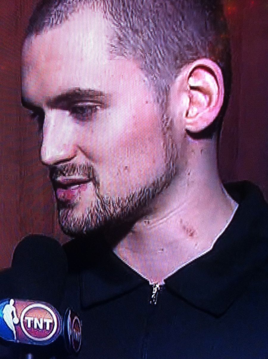 Judging By That Hickey, Kevin Love Had A Good All-Star Weekend