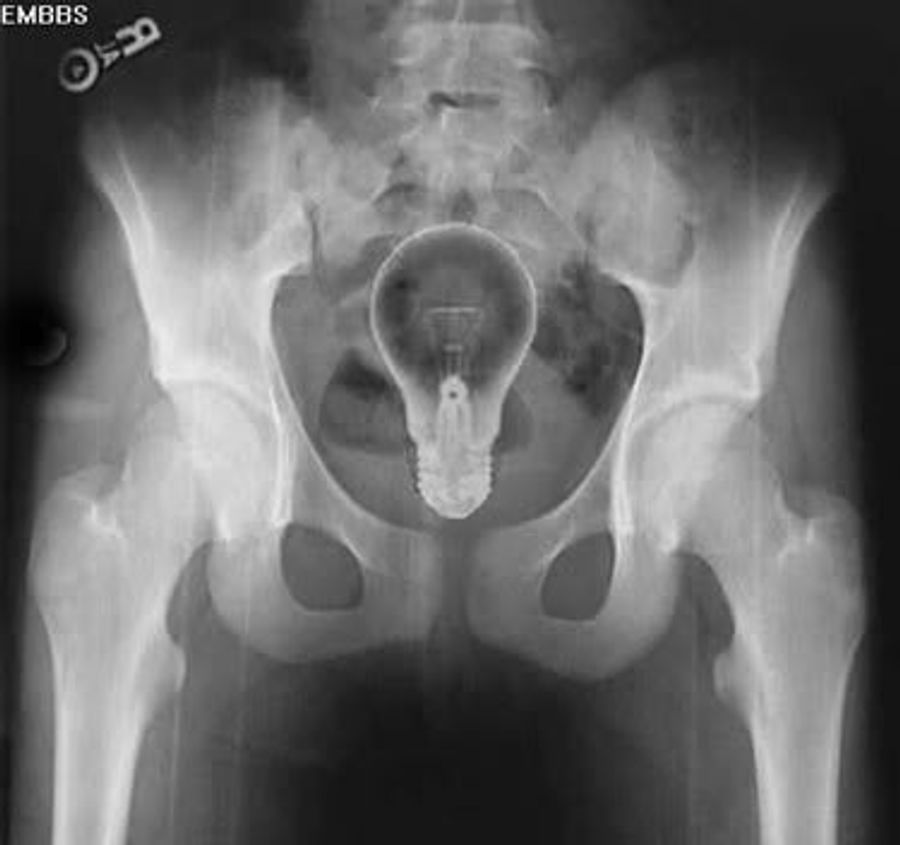 What Objects Are We Putting In Our Rectums?