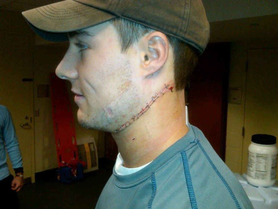The Result Of A Skate To The Neck Is Quite Frankensteiny
