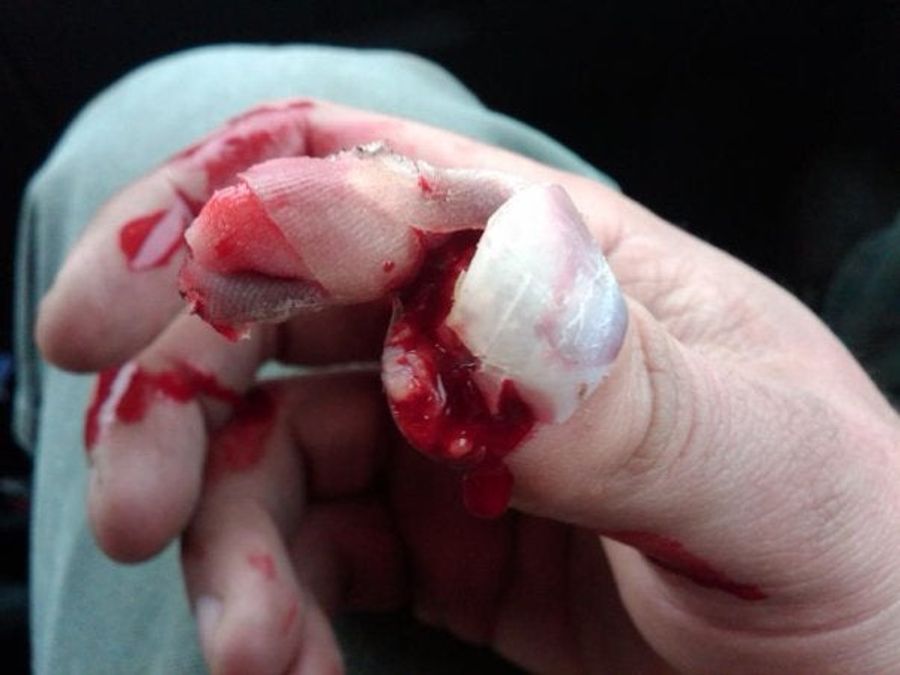 Blood Writes: "Cow crushed my thumb" (WARNING: STUPENDOUSLY GROSS)