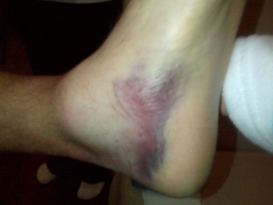 Take A Gander At Brett Favre's Disgusting Bruises
