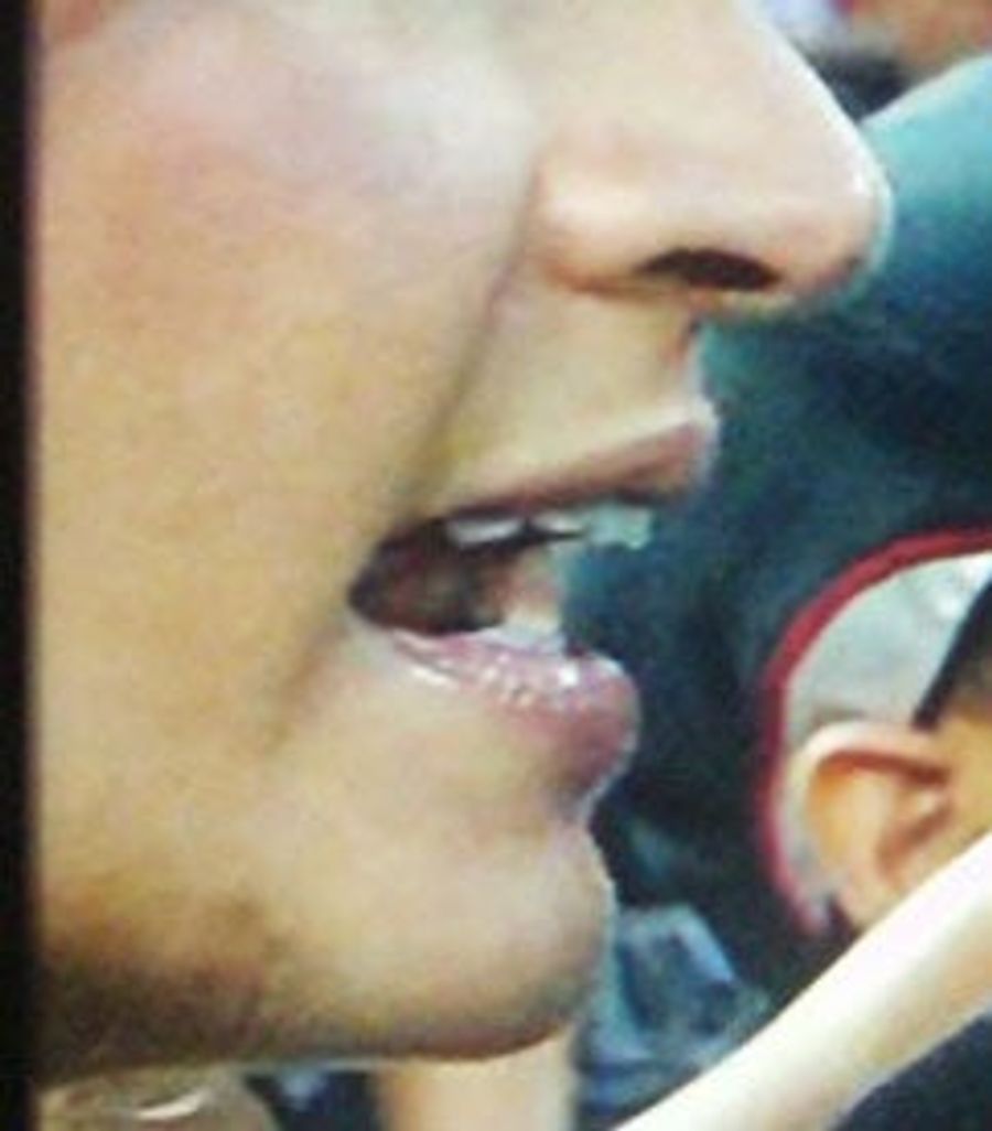 America&#39;s Sideline Chin Bruise