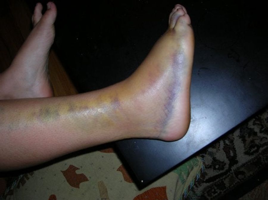 Ma'am, Your Foot Appears To Be Dying