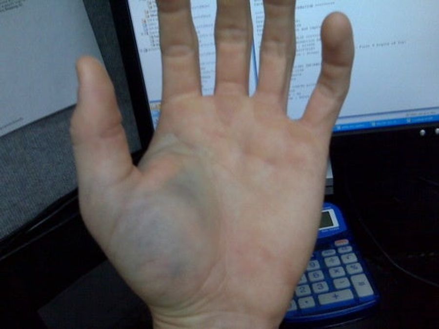 A Broken Thumb, Another Black Eye, And Our First Wiffle Ball Failure