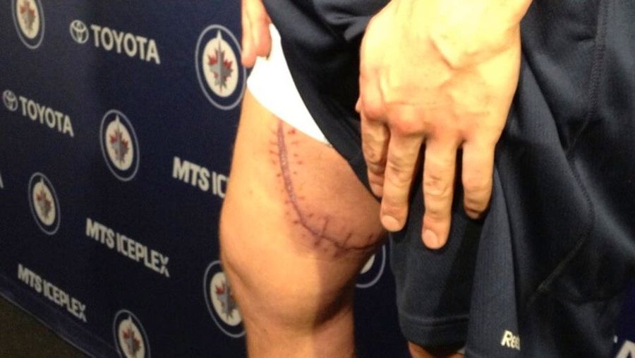 Hockey Player Who Got His Femoral Artery Slashed Open Has Ridiculous Scar