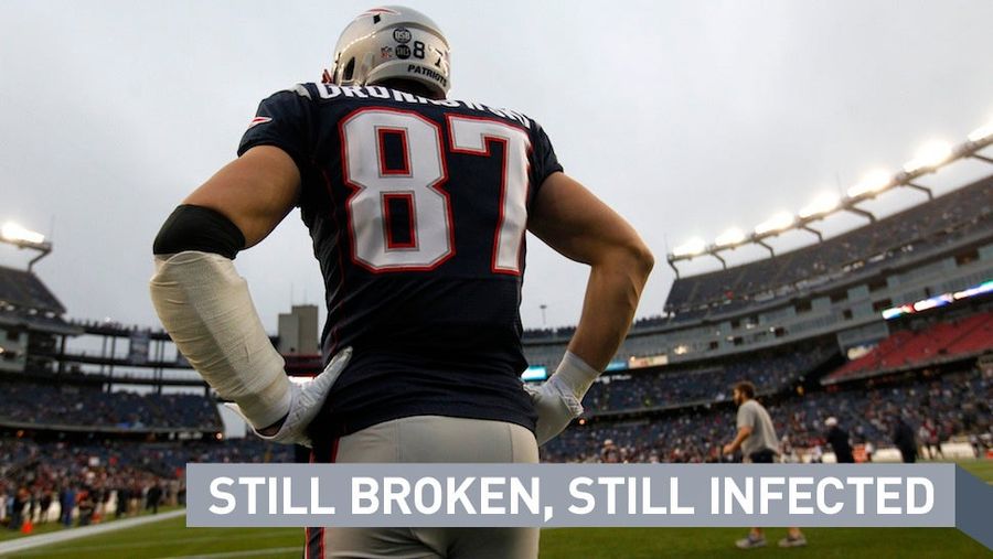 OK, Maybe It's Time For Patriots Fans To Start Panicking About Rob Gronkowski's Injured Arm