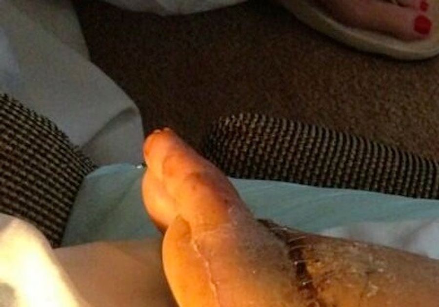 Snakebite Victim's Post-Surgery Foot Is Still Horrifying (NSFW)