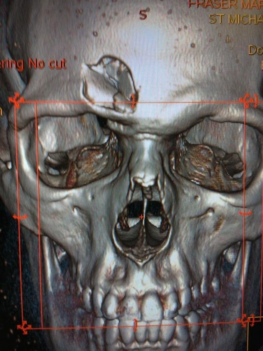 The Purported CT Scan Of Mark Fraser's Head Is Terrifying