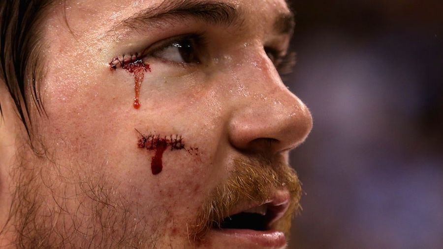 Andrew Shaw To Auction Off The Stitches From His Glorious Hockey Face