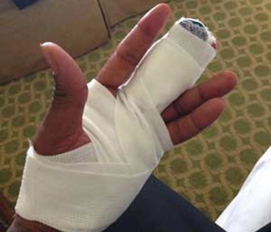 Rashad Johnson's Severed Finger Is Absolutely Disgusting