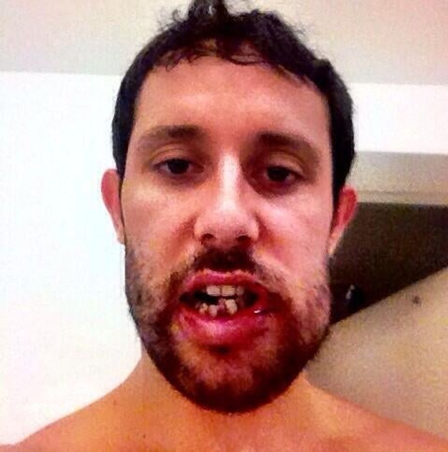 Sam Gagner&#39;s Broken Jaw Is Grotesque