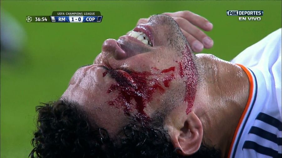 Here&#39;s Pepe Getting A Gash In His Face Stapled Shut On The Pitch
