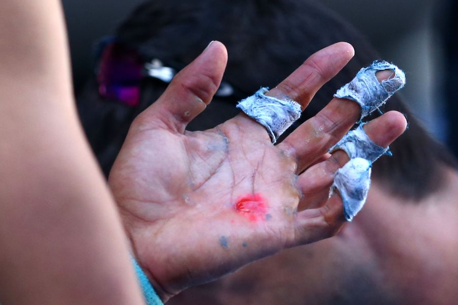 Rafael Nadal&#39;s Hands Are Disgusting