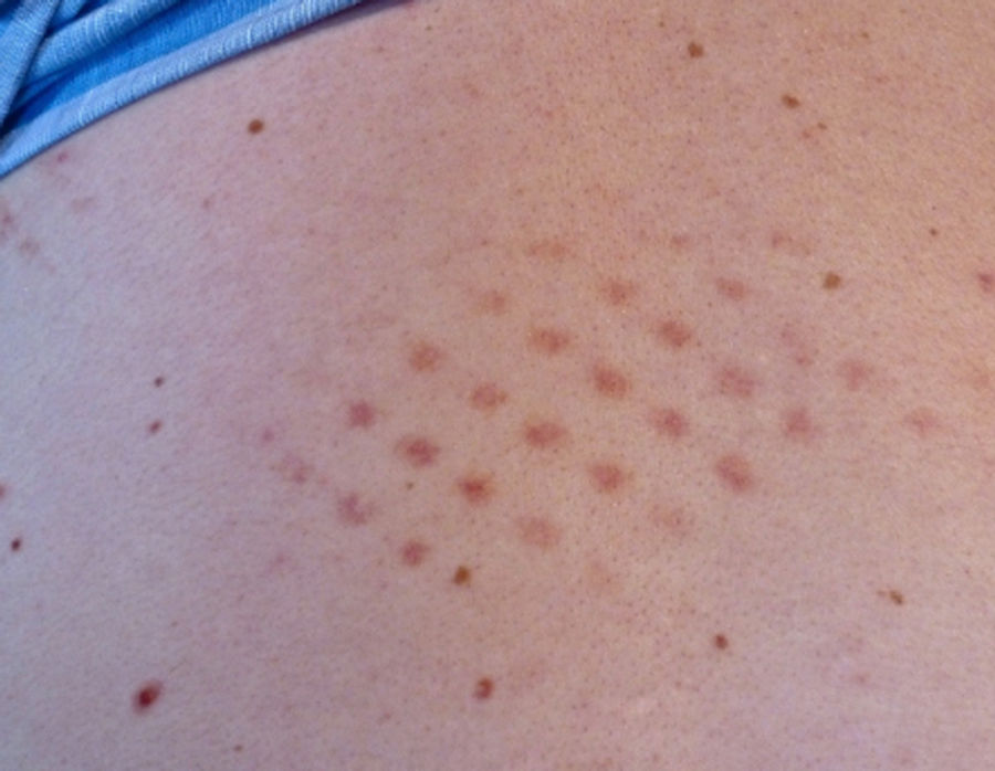 Man Goes To Mets Sleepover, Leaves With Gross Rash